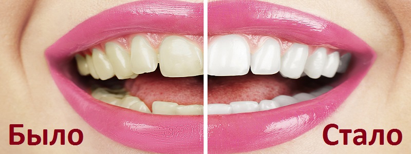 Исправление вида зубов 