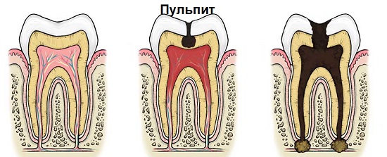 что такое пульпит зуба