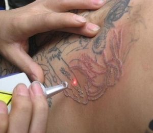 удаление татуировок