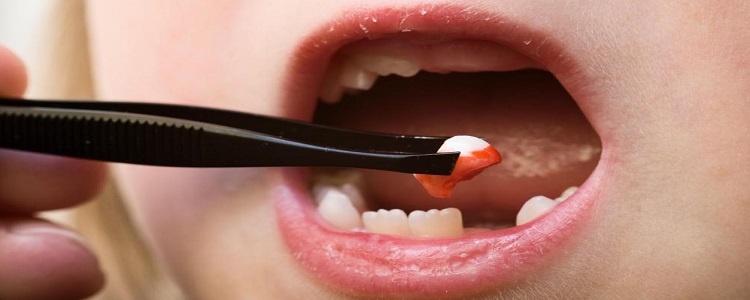 щипцы для удаления зубов