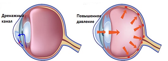 глазная глаукома